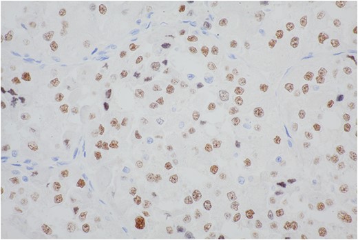 The majority of cells show moderate to strong nuclear staining with the antibody to the carboxy-terminal portion of TFE3 retained in the fusion protein.