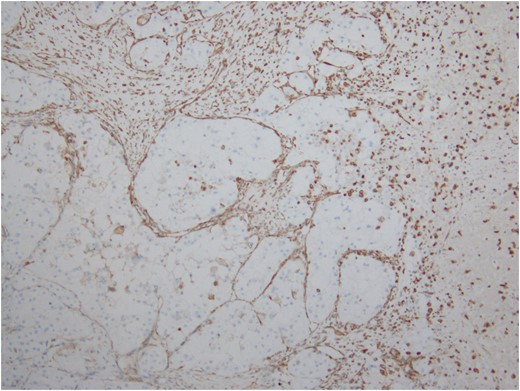 Immunostain for Vimentin outlines the delicate vascular envelope around group of tumor cells.