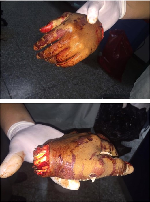 Hand amputation.