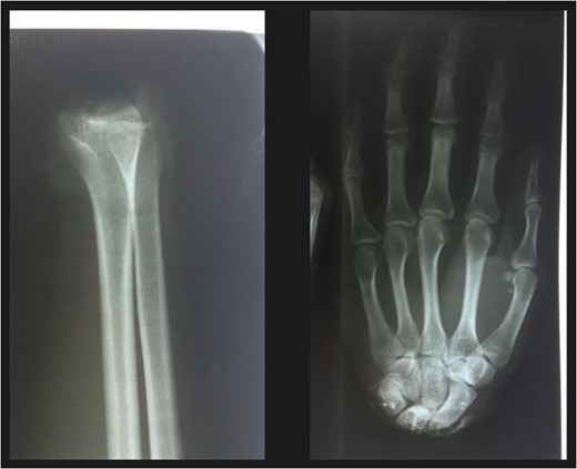 X-rays of the amputated limb