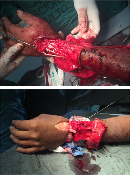 Reimplantation of the hand, with adequate blood supply and reconstruction of tendons.