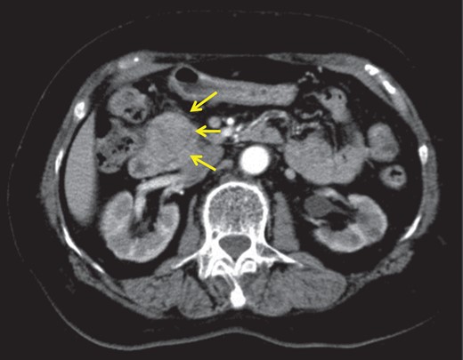 Abdominal enhanced computed tomography revealed hypervascular tumour, 3.5 cm in diameter at the pancreas head.