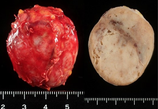 Surgical specimen. The tumour was well-circumscribed, white tone, elastic soft.