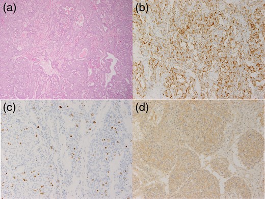 Pathological findings. (a) Hematoxylin and eosin stain (×40): the tumour showed honeycomb arrangement. (b) Insulin staining was positive. (c) Ki-67 index was 5%. (d) SSTR2a staining was positive.