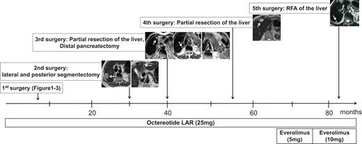 Clinical course of the patient. RFA, radiofrequency abration.