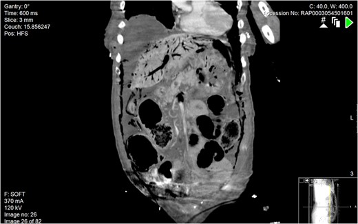 Coronal section of abdominal CT scan. A large amount of gas can be seen within the hepatic portal venous system.
