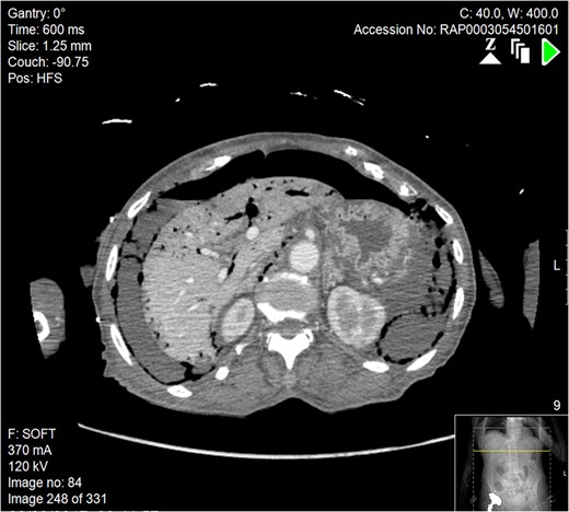 Axial section of abdominal CT scan. There is a significant quantity of free air and fluid within the abdomen, which can be seen adjacent to the liver, indicative of bowel perforation. Free air can also be seen in the portal venous system of the liver.