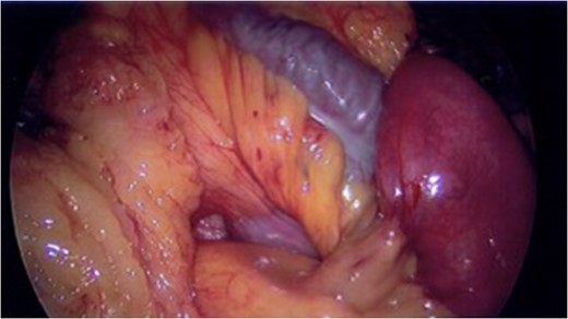 Photograph of Peterson’s defect laparoscopically following Roux-En-Y gastric bypass.