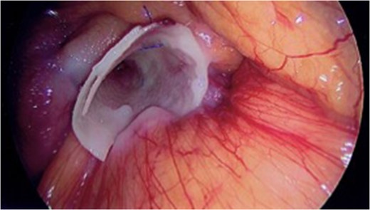 Laparoscopic view of the defect repair.
