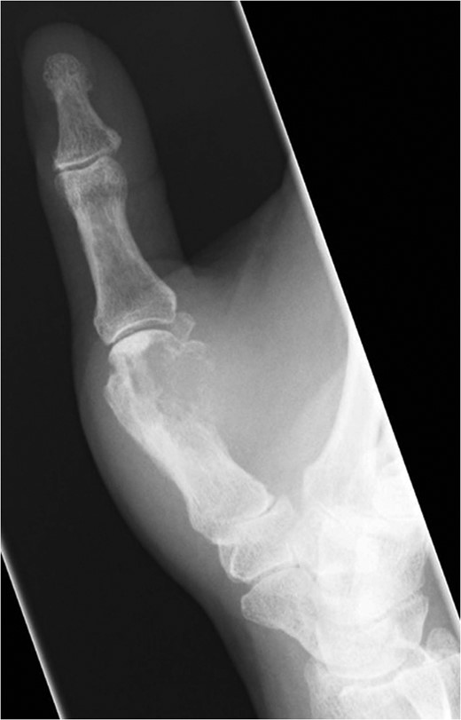 Plain radiographic image of right metacarpal bone destruction.