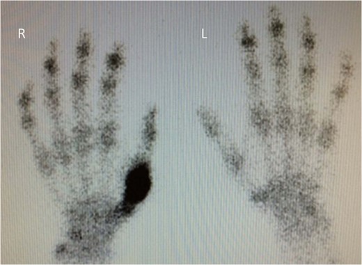 Technetium-99m HDP bone scintigraphy image demonstrating increased tracer uptake in the right thumb.