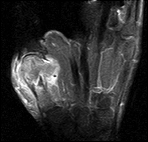 T1-weighted magnetic resonance image revealing a mass lesion with a high contrast effect and soft tissue involvement.