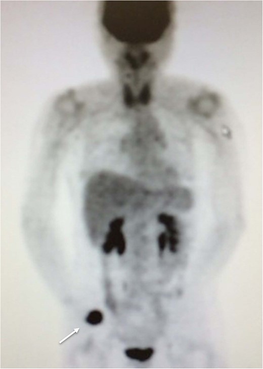 Fluorine-18 fluorodeoxyglucose positron emission tomography image depicting abnormal uptake in the right metacarpal bone (arrow), but no accumulation at other sites.