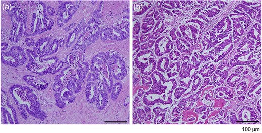 Histological evaluation of resected tumor tissues. (a) The rectal lesion specimen contained differentiated adenocarcinoma. (b) The specimen from the right metacarpal bone exhibited the appearance of adenocarcinoma, similar to that in the primary rectal lesion (hematoxylin and eosin stain, Ă—100 magnification).