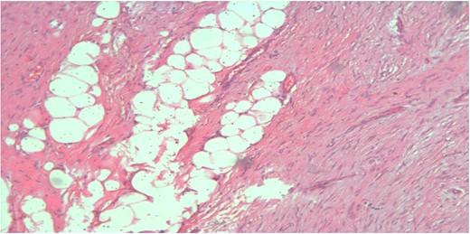 Spindle cell proliferation formed of bland looking cell arranged in short fascicles with dissection of breast fat lobules at the periphery (H&E, ×100x).