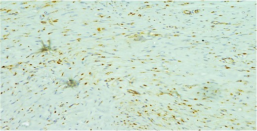 The cells showed diffuse positive nuclear staining for B-catenin (×200).