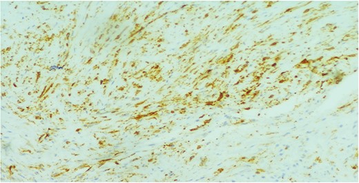 The cells showed focal cytoplasmic staining for ∞–SMA (×200).