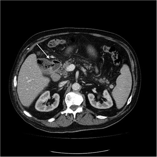 Computed tomography image of duodenal-ileal mass (arrow indicates cavity).