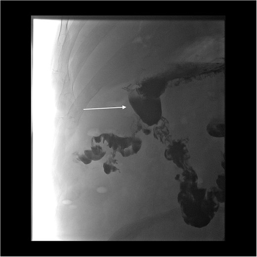 Oral contrast study showing transit of barium into the ileum from a duodenal source through a cavity (arrow indicates cavity arising from duodenum).