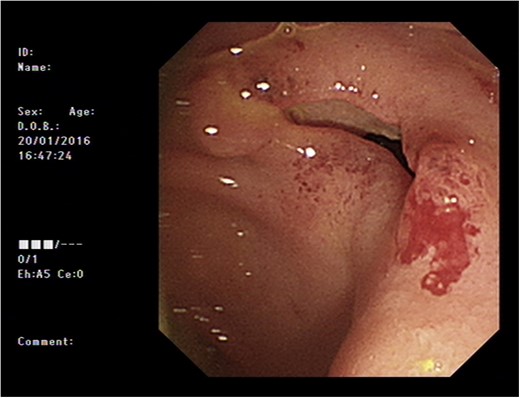 Endoscopic images of duodenum.