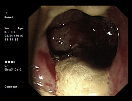 Endoscopic image through duodenal fistula.