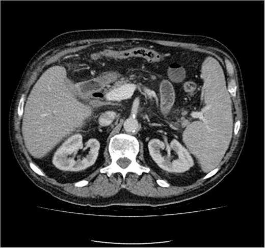Computed tomography image showing improvement in appearances (stent removed).