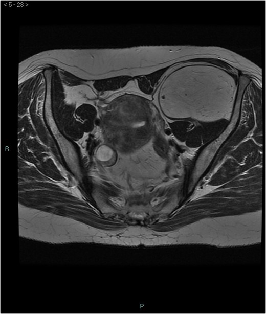 MRI axial-T2w.