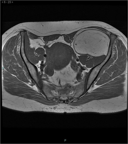 MRI axial-T1w.