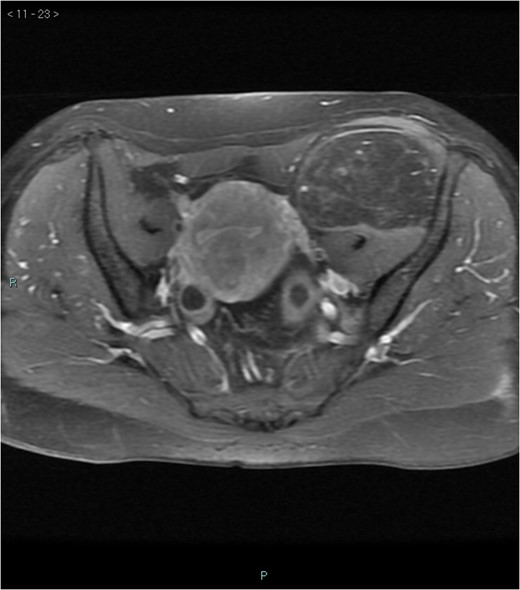 MRI axial-T1w with contrast.