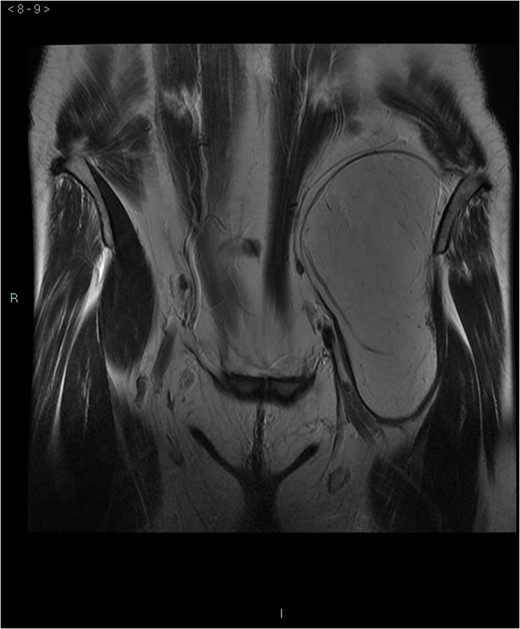 MRI coronal-T2w.