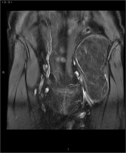 MRI coronal-T1w with contrast.