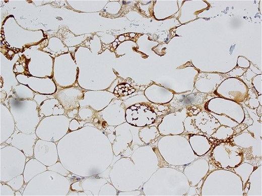 S-100 Immunohistochemical positivity.