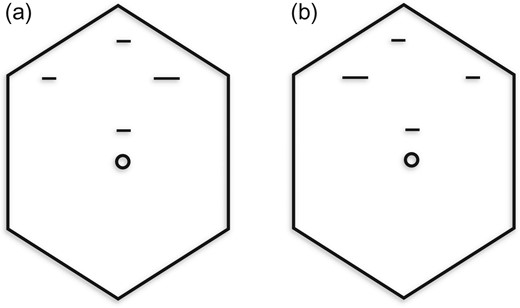 Port placement (5,5,5,10) for laparoscopic cholecystectomy: (a) normal anatomy and (b) situs inversus.