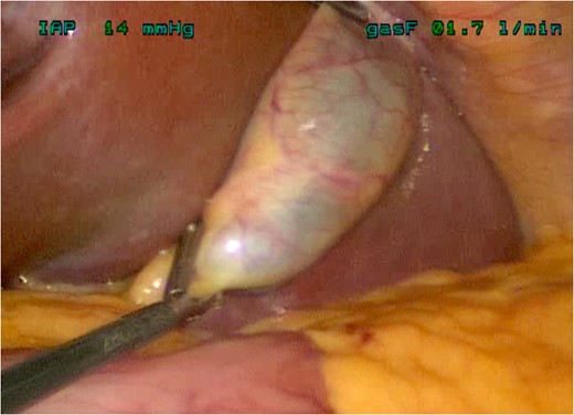 Gallbladder retracted above liver edge.