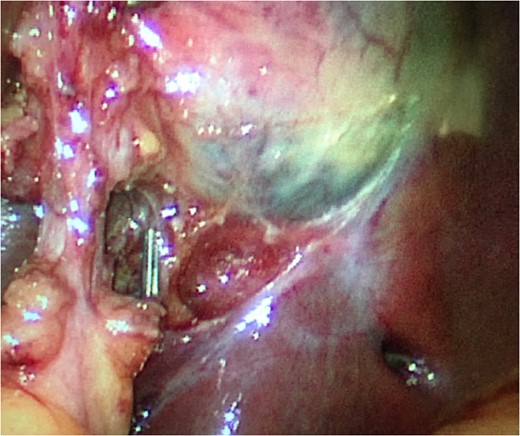 Clipped branch of the cystic artery and skeletonized cystic duct.