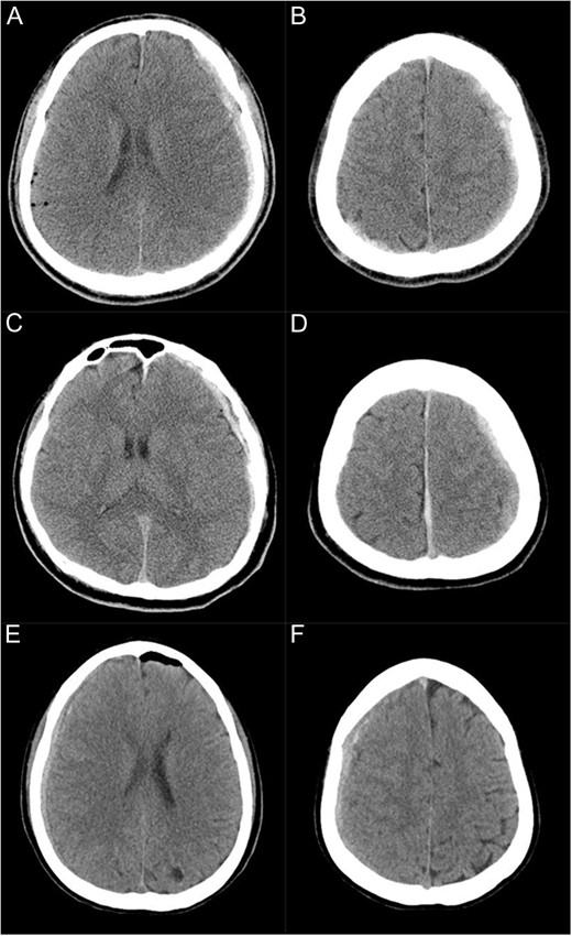 CT scans immediately after the surgery showing subdural haematoma in three cases (A and B: Case 1, C and D: Case 2, E and F: Case 3). (A and B) Subdural haematoma is present on the left supratentorial convexity as well as in the parieto-occipital area on the right side. (C and D) Subdural haematoma is present on the left supratentorial convexity and along the falx. (E and F) Subdural haematoma is present on the right supratentorial convexity.