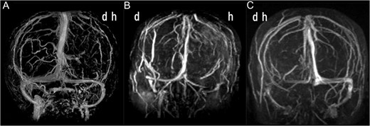 (A) Anteroposterior view of three-dimensional MR venogram after gadolinium enhancement of Case 1 showing the venous drainage is dominant on the right side. (B) MR venogram of Case 2 showing the venous drainage is dominant on the right side. (C) MR venogram of Case 3 showing the venous drainage is dominant on the left side. d, dependent side at operation; h, haematoma side.