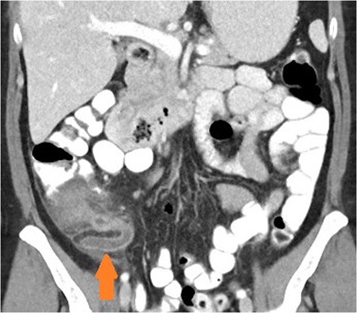Coronal view of patient with appendicitis. Dilated and thick walled appendix (arrow).