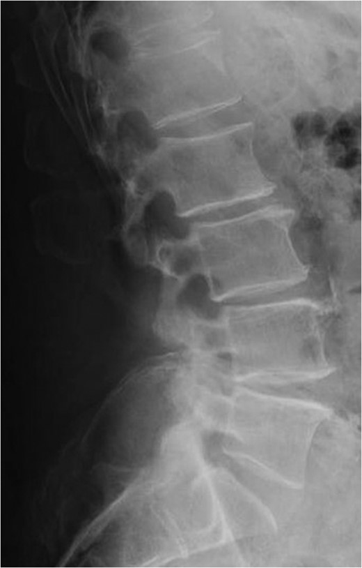 Standing lateral lumbar radiograph obtained 2 weeks following the patient's initial lumbar surgery (L3–S1 laminectomy). No instability is noted on the postoperative image.