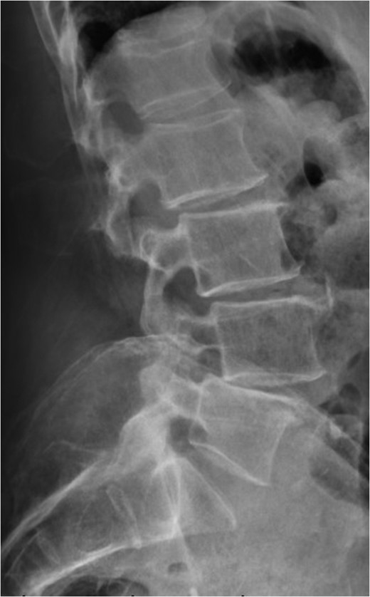 Standing neutral lateral lumbar radiograph obtained 17 months following the patient's L3–S1 laminectomy. The patient is now dealing with a Grade 1 anterolisthesis of L4 on L5, with a mild degree of retrolisthesis at each of the cranial levels depicted.