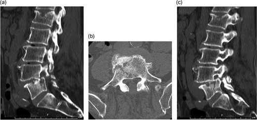 Median, parasagittal and axial images from a lumbar CT scan obtained following review of the patient's lumbar radiographs. (a) Sagittal CT demonstrating vertebral body split. (b) Axial CT demonstrating vertebral body fracture at L5. (c) Sagittal CT demonstrating pars fractures at L4.