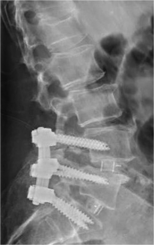 Standing neutral lateral lumbar radiograph obtained the day following the patient's L4–S1 revision decompression and posterior instrumented fusion with TLIF performed at each of these revised levels. A moderate correction of the prior L4-5 anterolisthesis was achieved and the patent's spine and construct appear stable.