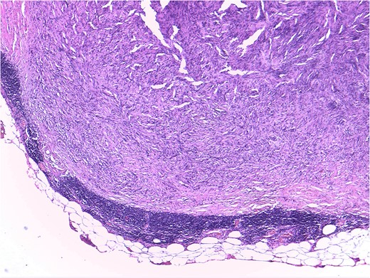 Mesenteric node tumor microscopically constituted by a spindle cell proliferation without atypia, mitosis or necrosis, displacing the normal limphatic tissue toward periphery.