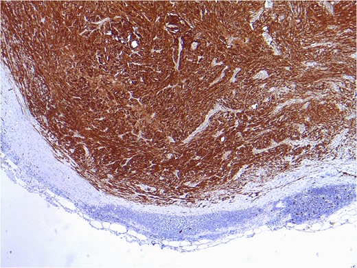 Positive result after immunohistochemical study for vimentin and protein S100, compatible with intranodal schwannoma.