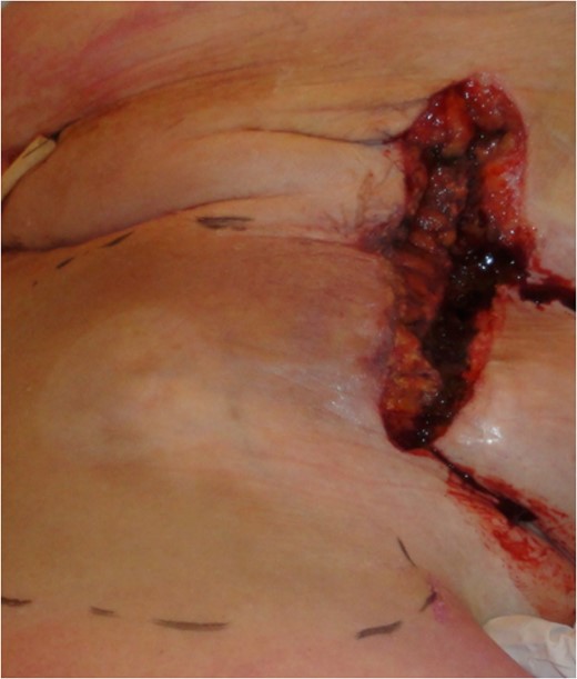 Macroscopic appearance after draining the hematoma and muscle transposition of the sartorius muscle.