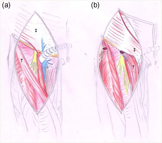Drawings before (a) and after (b) reconstruction with sartorius†- and oblique external‡ flap.
