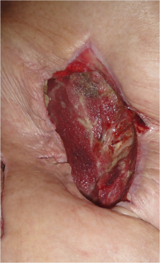 Appearance of the wound after removal of negative pressure, 4 days after the oblique external flap.