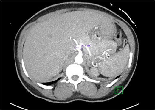 CT abdomen with contrast demonstrating the location and size of the aneurysm.