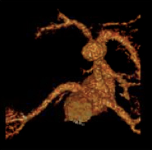 Recreated 3D imaging of the aneurysm arising from the ventral aspect of the distal celiac artery.