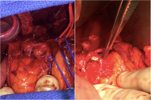 Intra-operative image demonstrating the anerusym in situ before repair (left) and the vascular patch repair following aneurysm removal (right). The pancreas is located inferior to the celiac artery in this image.